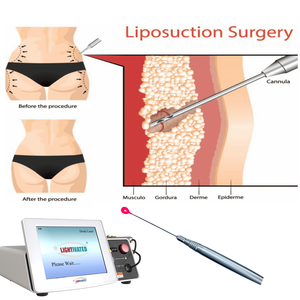 Máquina de Lipólisis Láser <span class=keywords><strong>No</strong></span> <span class=keywords><strong>Invasiva</strong></span> 2026 para Reducción de Grasa Sin Efectos Secundarios, Liposucción 980nm 1470nm Endoláser para Lifting Facial y Definición de Mandíbula - Product Image 5