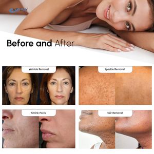 جهاز إزالة الشعر بالليزر من أجل magnemax Pro W ، جهاز تجديد الشعر بالليزر ، نبض طويل 1064 نانومتر 755 نانومتر Nd Yag alexandraine السعر Nd Yag - Product Image 5