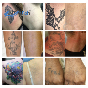 Máquina de Eliminación de Tatuajes con Láser de Picosegundos de Carbono Portátil Mini, Nd Yag con Tecnología Q-Switched para Uso Comercial - Product Image 6