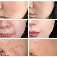 Sérum à l'acide mandélique AHA, acide salicylique, peeling acide, resurfaçage de la peau, réparation de la peau, blanchiment, régénération