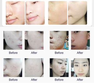 Mesin dermabrasi H2O2 gelembung kecil, mesin wajah untuk peremajaan kulit, mesin kecantikan dengan colokan US & UK - Product Image 6