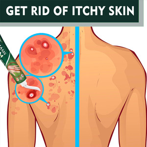 ครีมบำรุงผิวสำหรับใช้ในครัวเรือนครีมรักษาโรคสะเก็ดเงิน - Product Image 3