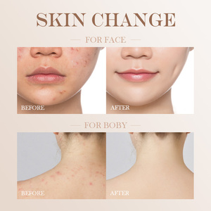 Commercio all'ingrosso Private Label biologico a base di erbe pulizia profonda antisettico Anti Acne & Pimles mare morto sapone di <span class=keywords><strong>zolfo</strong></span> - Product Image 4