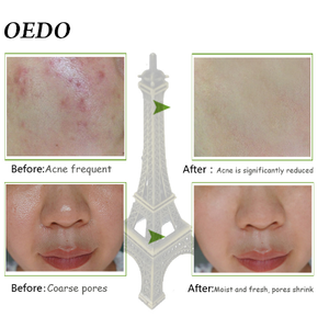 Alghe di <span class=keywords><strong>Aloe</strong></span> Vera Gel <span class=keywords><strong>crema</strong></span> per il viso con glicerina idratante sbiancante <span class=keywords><strong>crema</strong></span> per il giorno per l'acne collagene illuminante la cura della pelle - Product Image 5