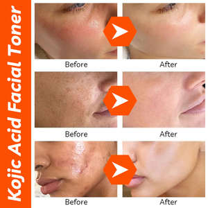 تونر حمض الكوجيك مزيل البقع الداكنة مفتح البشرة يوحد لون البشرة يزيل الشوائب وحب الشباب ومبيض للوجه - Product Image 6
