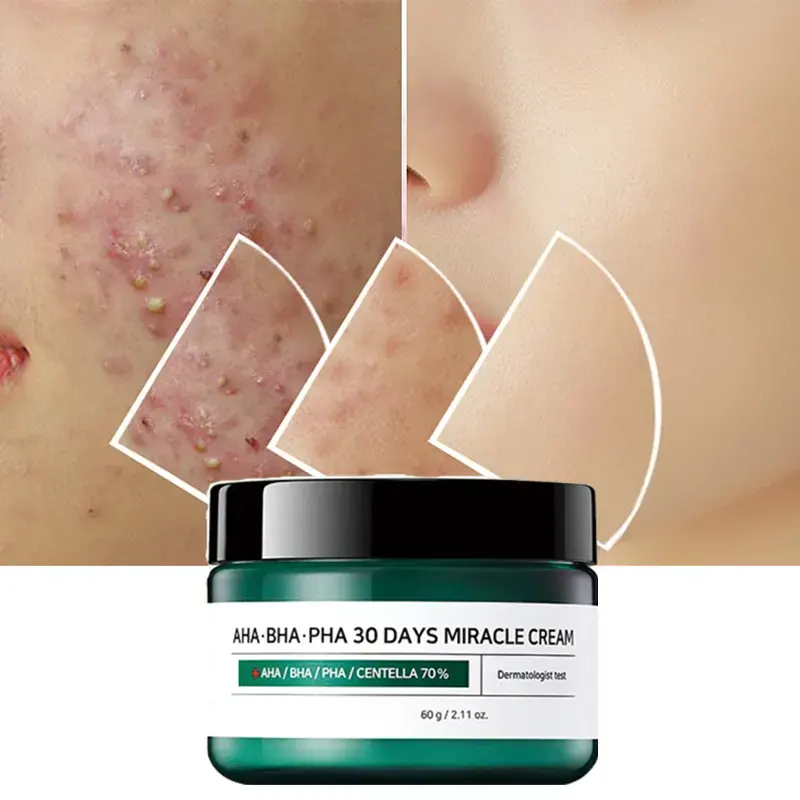 Blanqueamiento OEM 30 días minimiza la irritación calmar el tratamiento del acné AHA BHA milagro calma la piel sensible crema facial