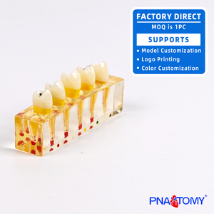 PNATOMY, modelo terapéutico patológico Dental de 5 componentes, muestra lesiones de caries, pulpa necrótica, absceso apical de plástico - Product Image 4
