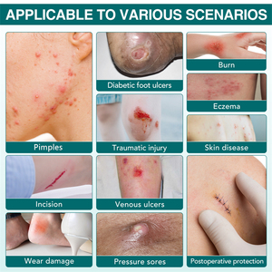 Pansement hydrocolloïde ELAIMEI en rouleau pour cicatrices, ulcères, blessures traumatiques, brûlures, <span class=keywords><strong>eczéma</strong></span>, incisions, dommages par usage, escarres, patch universel - Product Image 6