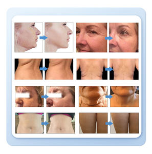 Tendance 2026 : Appareil HIFU 7D anti-âge pour lifting et raffermissement du <span class=keywords><strong>visage</strong></span> et du cou, anti-rides, avec brosse nettoyante pour le <span class=keywords><strong>visage</strong></span> et appareil HIFU 22D pour lifting du <span class=keywords><strong>visage</strong></span> - Product Image 6