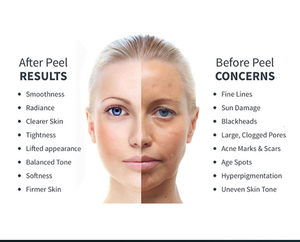 Máquina Portátil 4 en 1 Hydra Jet Peel, Hidrodermoabrasión con Oxígeno, Hidratante para la Piel, Uso Comercial, Máquina de Limpieza Facial - Product Image 3