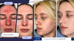 Dispositivo de Fototerapia LED de Alta Potencia con Salida de Longitud de Onda Estable para Resultados de Nivel Clínico en Estética Médica 7000A - Product Image 2