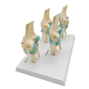 Life size human skeleton anatomical bone teaching model 4-stage diseased knee joint model