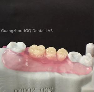 Suministros para dentaduras postizas DIY, dentadura postiza Invisible Valplast, buena nueva técnica protésica, prótesis para dentaduras postizas adelomórficas con buenos precios - Product Image 6