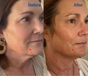 Máquina de belleza 4 en 1 HIFU 25 Max HIFU RF para eliminación de arrugas, HIFU 22D MAX ICE para reafirmar y tensar la piel, ideal para salones de belleza. - Product Image 6