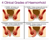 Système d'ablation Diodo Laser 980nm 1470nm moyen le plus efficace et le plus sûr de traiter les hémorroïdes/dispositif de traitement des hémorroïdes