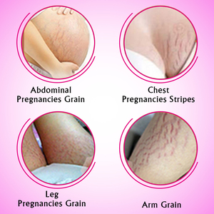 Lkiae căng đánh dấu loại bỏ kem tự nhiên Vitamin E an toàn & hiệu quả chống sau sinh sâu loại bỏ căng đánh dấu Kem - Product Image 3