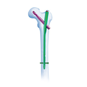CE Onaylı Titanyum Alaşımlı PFNA İntramedüller Çivi Sistemi Proksimal Femoral Kırık Cerrahisi için Sınıf III Ortopedik İmplantlar - Product Image 1