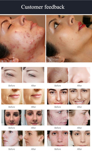 เครื่องพ่นน้ำขัดผิว H202 Aqua Peel เครื่องดูแลผิวหน้า เครื่องไมโครเดอร์มาเบรชั่น - Product Image 6