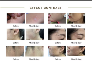 Máquina de Rejuvenecimiento Facial con Láser Fraccional de CO2 2026, el <span class=keywords><strong>Mejor</strong></span> Láser de CO2 para Rejuvenecimiento de la Piel, Eliminación de Arrugas y Acné, Cepillo de Limpieza Facial - Product Image 5