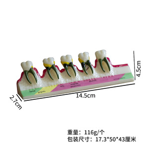 Modelo Anatómico de Caries Dental de Resina, Modelo de Exhibición de Decadencia Dental con Sellador de Fisuras, Modelo de Clasificación Periodontal - Product Image 5
