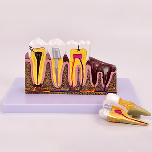 Modèle de caries dentaires pathologiques, modèle pédagogique complet de pathologie dentaire, modèle anatomique du dôme dentaire - Product Image 2