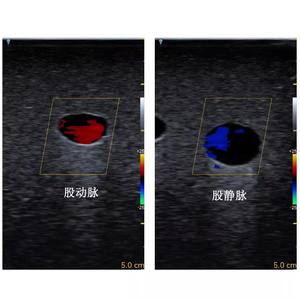 Simulador de Treinamento Médico ECMO para Treinamento de Punção de Artéria <span class=keywords><strong>Femoral</strong></span> e Veia Guiada por Ultrassom - Product Image 3