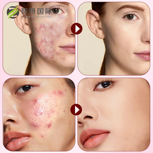 Tùy chỉnh Hữu Cơ Hydrocolloid mụn vá hình trái tim dầu cây trà mặt salicylic axit Niacinamide điều trị mụn trứng cá - Product Image 4