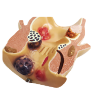 ADA thoát vị bẹn gián tiếp 1/2 kích thước cuộc sống, 1 phần và mô hình bệnh lý của trực tràng, 1 phần Mô hình giải phẫu bệnh lý - Product Image 5