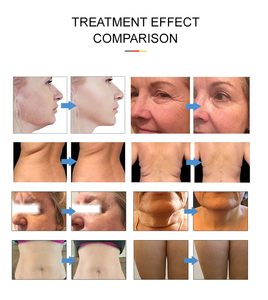 Machine Hifu anti-rides 7D, lifting du <span class=keywords><strong>visage</strong></span>, traitement facial, mini machine Hifu pour salon de beauté, brosse de nettoyage du <span class=keywords><strong>visage</strong></span>, 7 cartouches - Product Image 5