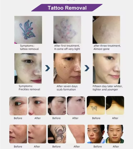 Appareil de suppression des pigments et de l'acné avec laser Nd Yag Q-Switched vertical Picolaser - Product Image 6