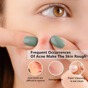 厂家批发面部粉刺贴剂，消除粉刺，减少发红，水杨酸面部粉刺贴剂 - Product Image 4