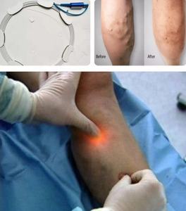 Fibra plana radial óptica Médica Quirúrgica reutilizada esterilizada para cirugía liposucción venas varicosas <span class=keywords><strong>piernas</strong></span> cirugía invasiva láser - Product Image 2