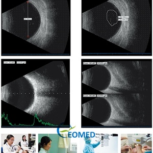 Equipo Óptico, Escáner Oftálmico B-Scan, Escáner A/B, Biomicroscopia por Ultrasonido EUS500 - Product Image 6