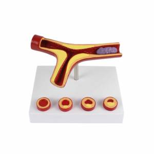 Herramienta de Enseñanza de Educación Médica, Modelo Educativo de <span class=keywords><strong>Arteriosclerosis</strong></span> de 10 Veces el Tamaño Real, Modelo de Arteria - Product Image 1