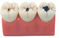 Modelo anatómico de enfermedad de caries dental con resina de aumento 3x modelo de cabeza de ciencia médica de PVC para escuelas entrenamiento de hospitales