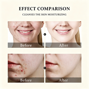 Tonique Visage Anti-Acné à l'Acide Salicylique et à l'Extrait d'Hamamélis, Contrôle du Sébum, Éclaircissant et Exfoliant, Marque Blanche - Product Image 2