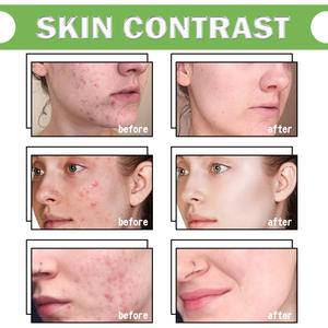 EELHOE Gel de Aloe Vera Clear Acne Defense Gel Hidratante Calmante y Calmante de Imperfecciones Eliminación de Acné Gel PARA EL Cuidado DE LA Piel - Product Image 6