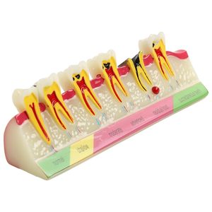 Dental <b>Teeth</b> Model 6-Stage Caries Development Educational Model for Periodontal Disease Patient Display - Product Image 1