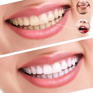 Venta al por mayor spray <span class=keywords><strong>bucal</strong></span> para mal aliento Enjuague <span class=keywords><strong>bucal</strong></span> Kits de líquido para blanquear los dientes - Product Image 4