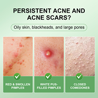 Sérum Visage 10% Acide Azélaïque Anti-acné, Contrôle du Sébum, Réduction des Pores, Rafraîchissant, Centella, Vitamine B5, Hydratant, Acide Hyaluronique