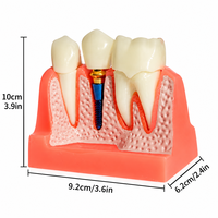 Modèle d'implant dentaire pédagogique, modèle détachable de couronne dentaire et de visqueuse pour la formation des dentistes et l'affichage en clinique