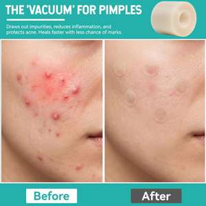 Pansement hydrocolloïde auto-adhésif extra fin à cicatrisation rapide pour les escarres, les brûlures, les ampoules, les soins de l'acné, stérile et imperméable - Product Image 5