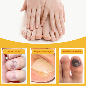 מסמר הסרת פטרת קרם onychomycosis טיפול פטרייתי ponychomycosis petral - Product Image 3