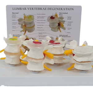 โมเดลกระดูกสันหลังส่วนเอวทางพยาธิวิทยาแบบ<span class=keywords><strong>4</strong></span>ขั้นตอนเครื่อง<span class=keywords><strong>ม</strong></span>ือฝึกศัลยกรร<span class=keywords><strong>ม</strong></span>กระดูกพร้อ<span class=keywords><strong>ม</strong></span>บัตรสำหรับการศึกษาวิทยาศาสตร์การแพทย์ - Product Image 3