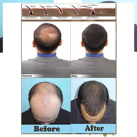 Huile de croissance rapide des cheveux Adivasi Anti-chute des cheveux, traitement d'épaississement des cheveux, essence d'huile pour la repousse des cheveux pour femmes et hommes