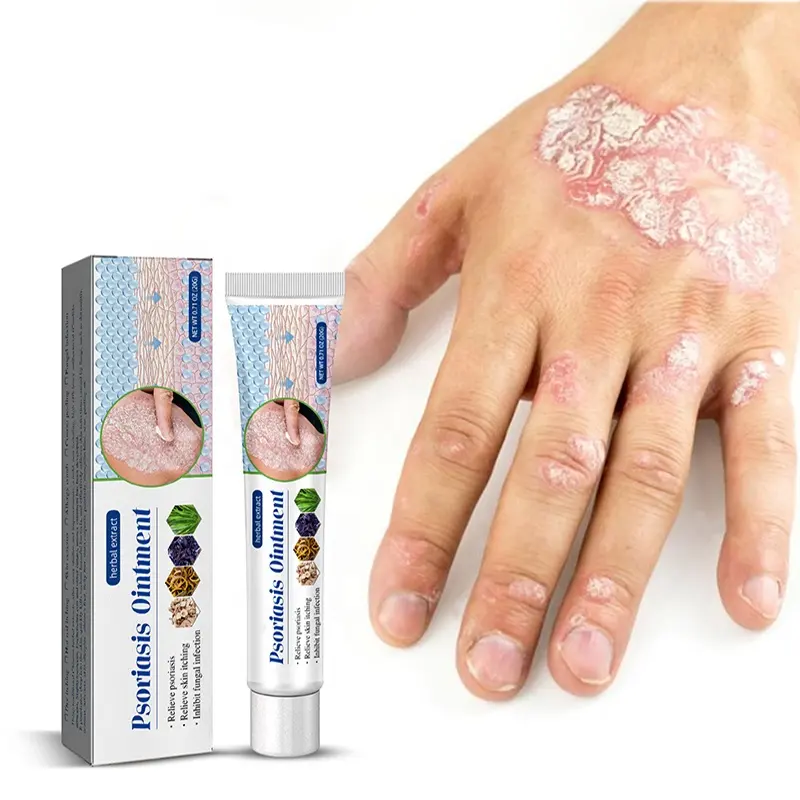 20g de pommade contre le psoriasis, dermatite d'acné, scrotum, eczéma, pityriasis, urticaire, crème de traitement du psoriasis