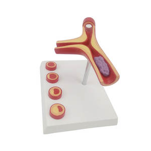 Demonstrador de Arteria Tipo Y DARHMMY - Material de PVC con Aterosclerosis y Trombosis para Educación y Entrenamiento Médico - Product Image 2