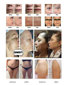 Máquina de Belleza SMAS 2026, la Más Nueva, para Lifting de Cuello y Ojos, para Salón de Belleza y Uso Doméstico - Product Image 6