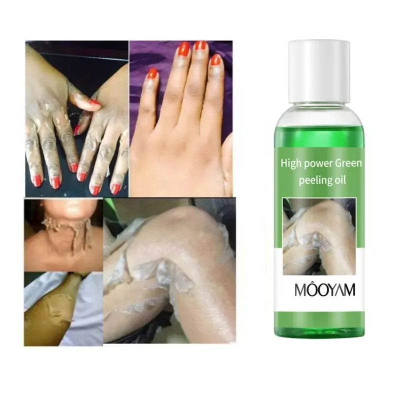 ผิวไวท์เทนนิ่งเครื่องหมายยืดRemoversแผลเป็นRemoverจุดด่างดําRemover 100Ml MOOYAMพลังงานสูงสีเหลืองและสีเขียวPeeling Oil