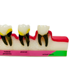 Nuevo Modelo Dental de Alta Calidad, Modelo de Clasificación Periodontal B, Modelo de Enseñanza Dental - Product Image 5